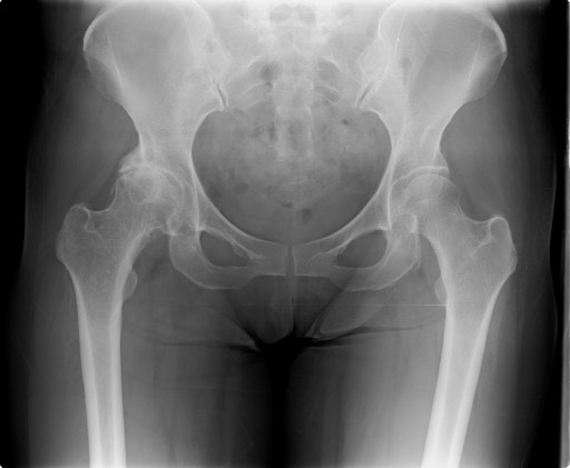 股関節の痛み、股関節痛の改善方法と予防